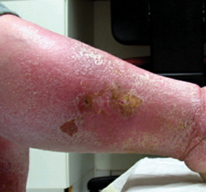 Sekundäre Lymphödeme: „Diagnose und Therapie weiterhin unbefriedigend“