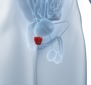 Diagnostik und Therapie des benignen Prostatasyndroms