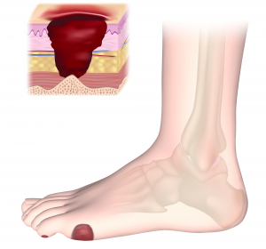 Herausforderung „diabetisches Fußsyndrom“