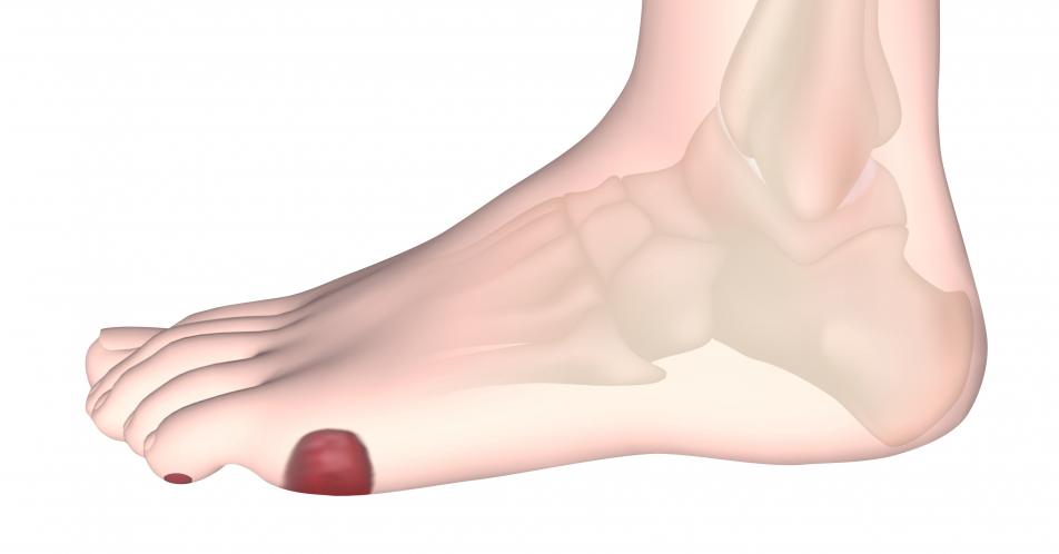 Herausforderung „diabetisches Fußsyndrom“