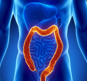 Akute Colitis ulcerosa: Mesalazin-Tabletten mit neuer Wirkstärke