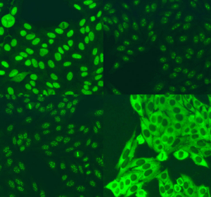 Kollagenosen: Heterogene Autoimmunerkrankungen mit antinukleären Antikörpern als Gemeinsamkeit