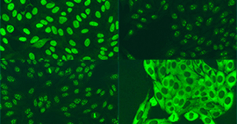 Kollagenosen: Heterogene Autoimmunerkrankungen mit antinukleären Antikörpern als Gemeinsamkeit