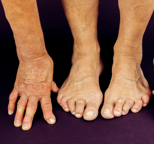 Diagnostik und Therapie bei Rheumatoider Arthritis