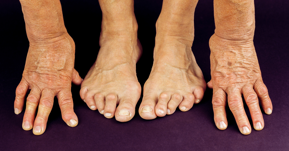 Diagnostik und Therapie bei Rheumatoider Arthritis