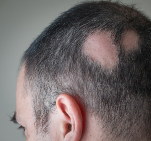 Androgenetische Alopezie: Neue S3-Leitlinie empfiehlt Minoxidil zur topischen Behandlung