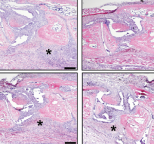 Rheumatoide Arthritis: Neue „Zielscheibe“ für nebenwirkungsarme Kortisontherapie