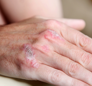 Auswahl des Biologikums bei Psoriasis: Individuelle Patientenkriterien berücksichtigen