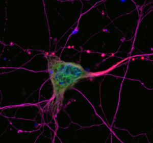 Neuer ALS-Bluttest: Hilfe bei der Differenzialdiagnose und Hinweise auf Krankheitsverlauf