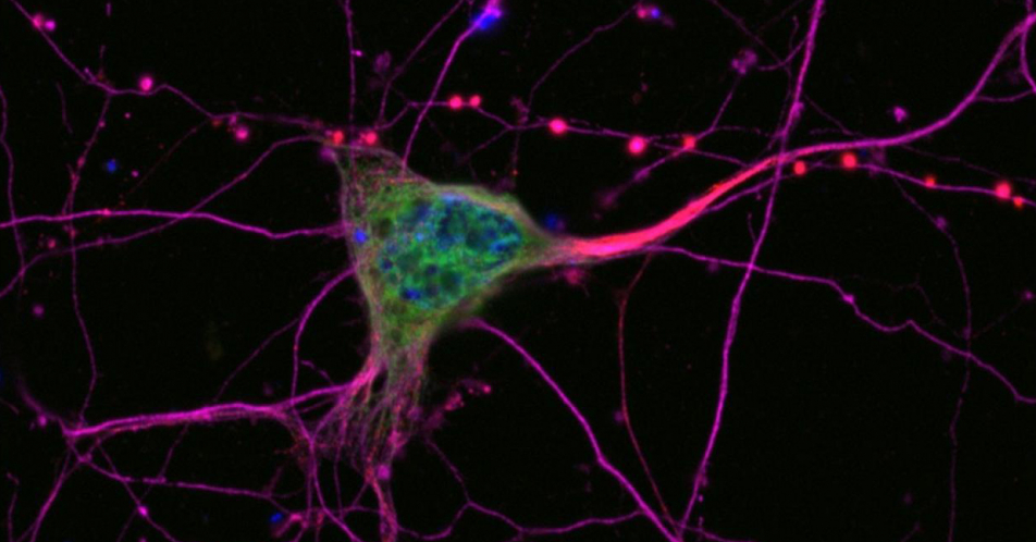 Neuer ALS-Bluttest: Hilfe bei der Differenzialdiagnose und Hinweise auf Krankheitsverlauf