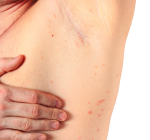 Wirksame Therapien bei Urtikaria-Vaskulitis