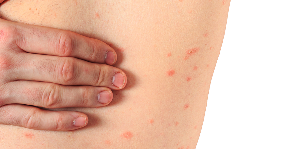 Wirksame Therapien bei Urtikaria-Vaskulitis