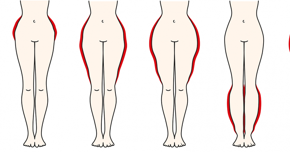 Oft unerkannt: Frauenkrankheit Lipödem