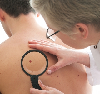 Hautkrebs-Früherkennung durch Screenings