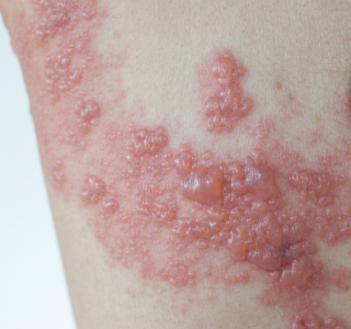 Gürtelrose: Schmerzender Ausschlag